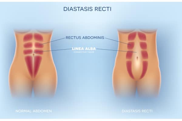 What Non-Surgical Options Are Available for Diastasis Recti Haverhill?