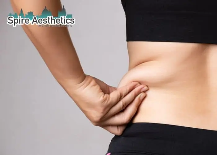 Image of woman pinching fat on their hips Haverhill. Fat Freezing treatment