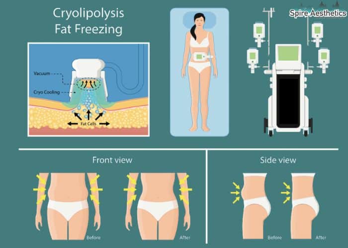 Image of diet and fat freezing combined for best results for Spire Aesthetics Haverhill