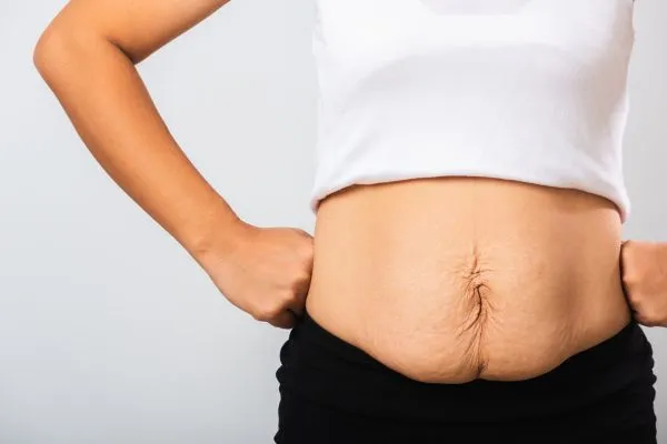 Image of a woman's stomach after weight loss with sagging skin following a gastric band Haverhill
