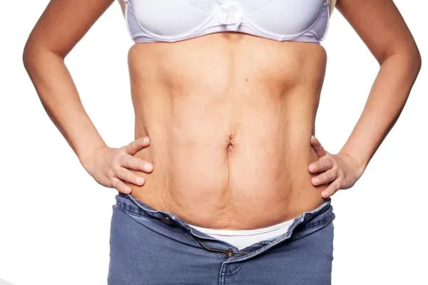 sagging skin on woman's stomach after weight loss injections Haverhill