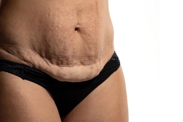 Image of womans stomach after weight loss injections Haverhill showing saggy skin