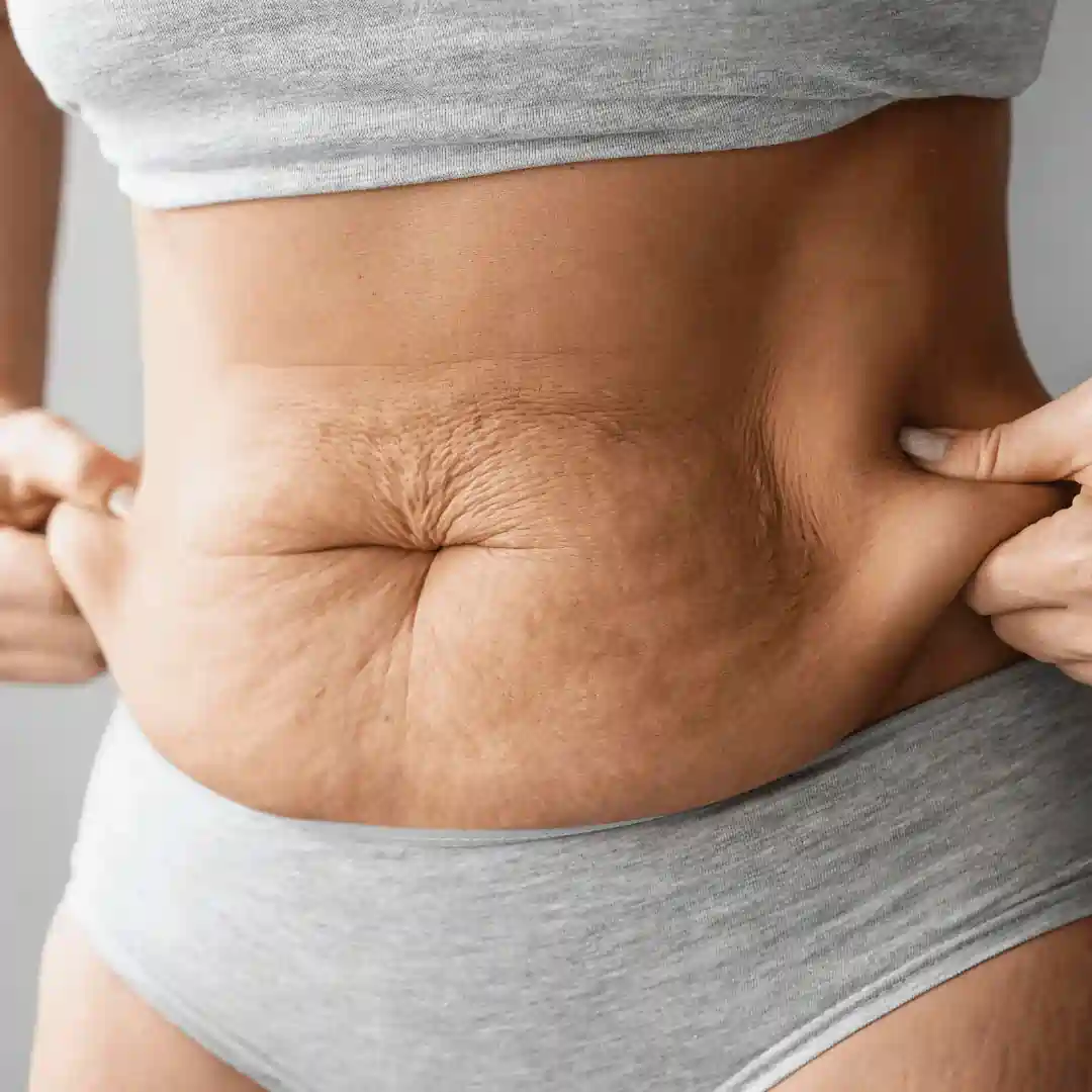 Is It Normal to Have Loose Skin After Pregnancy Haverhill?